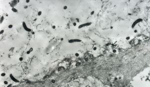 F,52y. | colon … spirochetosis … subepitheliai microbes F,52y. | colon … spirochetosis … subepitheliai microbes